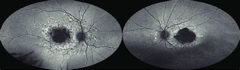 Green Light Ultrawide Field Fundus Autofluorescence Uwf Faf Optos