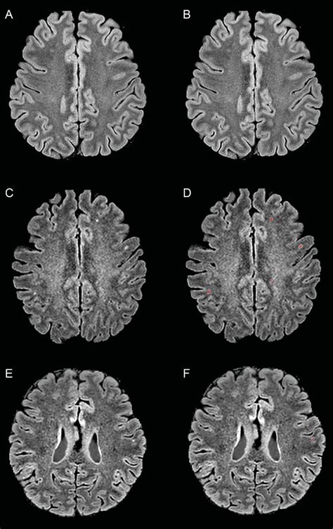 Figure Representative Deep White Matter Hyperintensity Segmentation