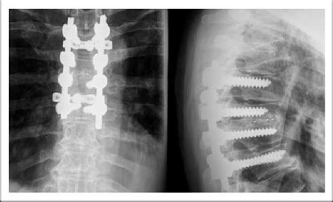 Osteomyelitis X Ray Spine