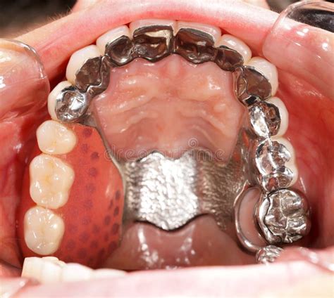 Dental Prosthetics stock photo. Image of health, prosthetics - 30753572