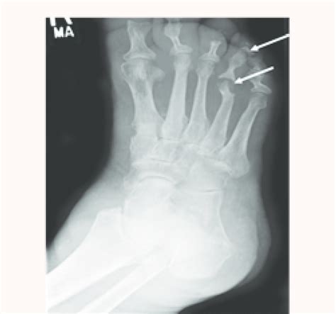 Radiograph Showing Osteomyelitis Among Metatarsal And Phalanges