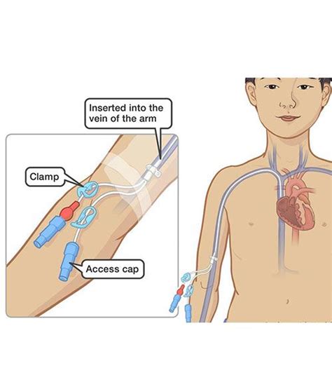 Hickman line, PICC line insertion for Bone – Dr. Kushan Nanavati ...