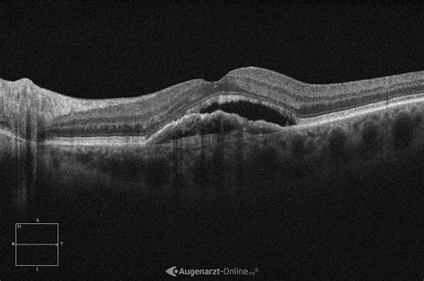 Altersbedingte Makuladegeneration Atlas Der Augenheilkunde