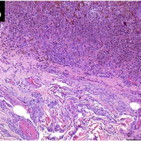 Histopathological Analysis Showing Mild Peritumoral Inflammatory