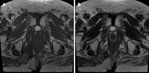 Follow Up Magnetic Resonance Imaging After 24 Mo There Is No