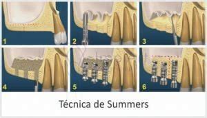 Enxerto ósseo e implante no mesmo dia Técnica de Summers