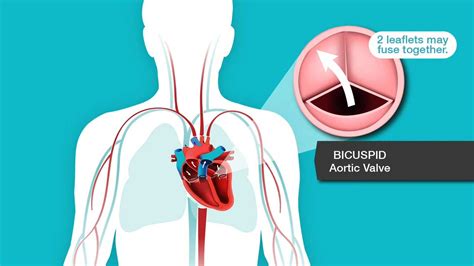 Problem Heart Valve Stenosis American Heart Association