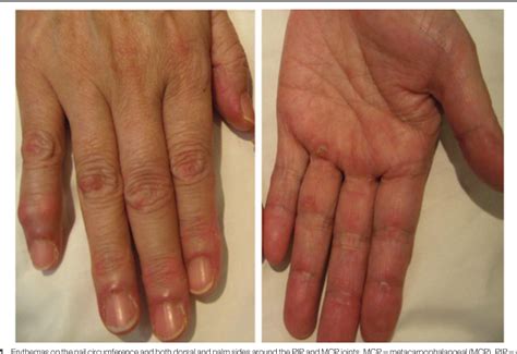 Figure From Recurrence Of Anti Mda Antibody Positive Clinically