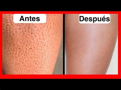 Como Quitar Los Puntos Negros De Las Piernas Qubico