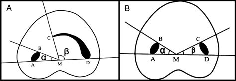 analysis   shaped canals  panoramic radiography  cone beam