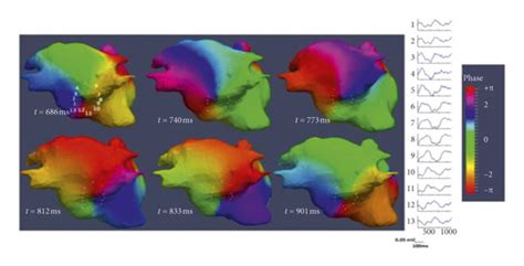 Noninvasive Body Surface Mapping A The Vest Of 252 Electrodes And