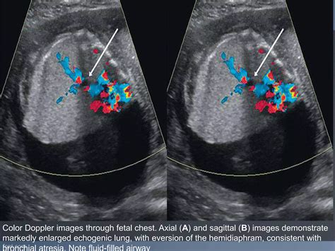 Ultrasound Evaluation Of Fetal Thorax Ppt