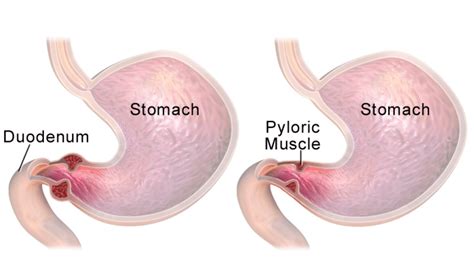 Pyloric stenosis - Clinical features - Management - TeachMePaediatrics