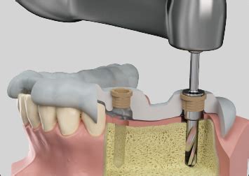 Guided Surgery C Tech Implant Global Supplier Of Dental Implants