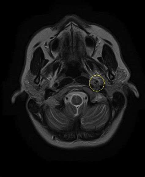 First MRI of acute left internal carotid artery dissection. | Download ...