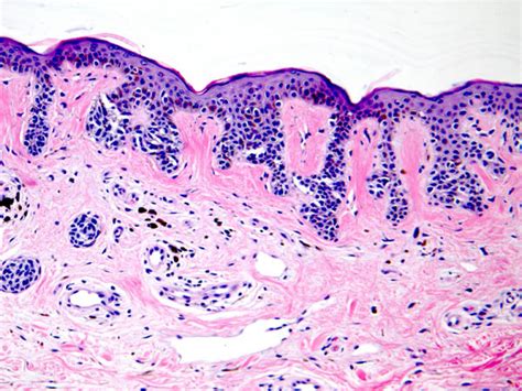 Melanocytic Nevi Including Atypical Nevi Dysplastic Nevi Nevus With