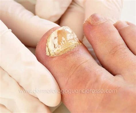 Dermatologo Malattie Unghie A Sant Ippolito E Fossombrone Dott Ssa