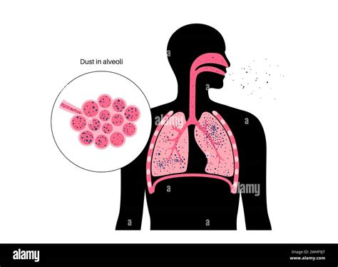 Pneumoconiosis Lung Disease Illustration Stock Photo Alamy