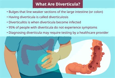 Understanding Diverticular Disease Causes Symptoms And Treatment