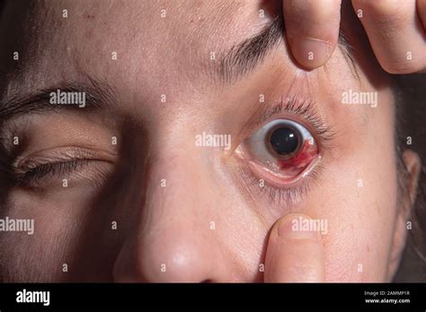 Eye Hemorrhage Hi Res Stock Photography And Images Alamy