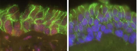 Interstitial Lung Disease Ucsf Pulmonary Critical Care Allergy And