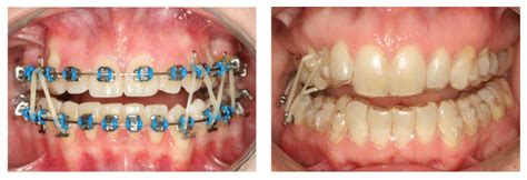 Elásticos Intermaxilares En Ortodoncia ¿qué Son Y Para Qué Se Utilizan