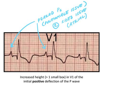 EKG Flashcards Quizlet