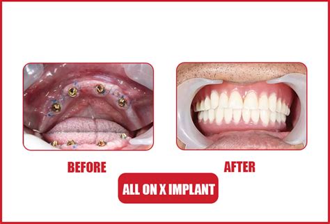 ALL ON 4 IMPLANT AT SAI GON IMPLANT DENTAL CENTER - Saigon Implant ...