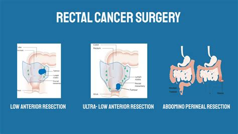rectal cancer surgery surgery  colon cancer macmillan cancer
