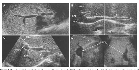 Figure 1 From An Anomaly In Persistent Right Umbilical Vein Of Portal