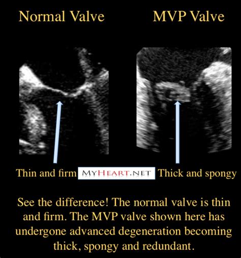 Myxomatous Mitral Valve Disease - Captions Beautiful