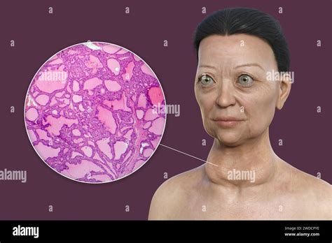 Illustration Depicting A Woman With Graves Disease Showing An Enlarged Thyroid Gland And