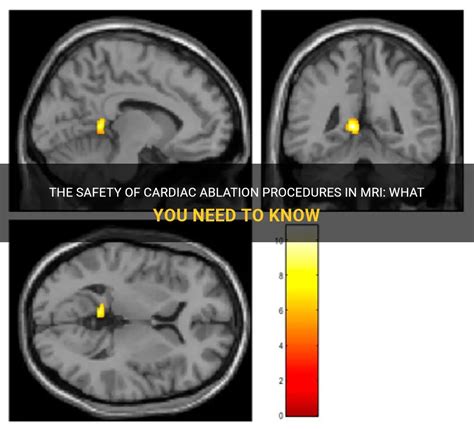 The Safety Of Cardiac Ablation Procedures In Mri What You Need To Know Medshun