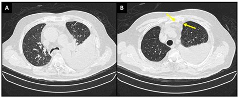 Diagnostics Free Full Text Primary Effusion Lymphoma A Rare And