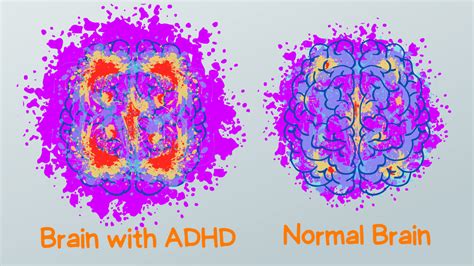 ADHD Brain vs Normal Brain: Functions, Differences & More