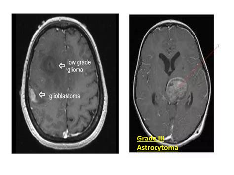 Intracranial Space Occupying Lesions Ppt