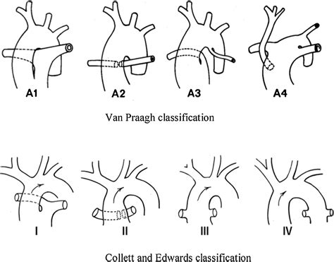 A Rare Case Of Truncus Arteriosus Van Praagh Type A3 Prenatal Diagnosis And Postnatal