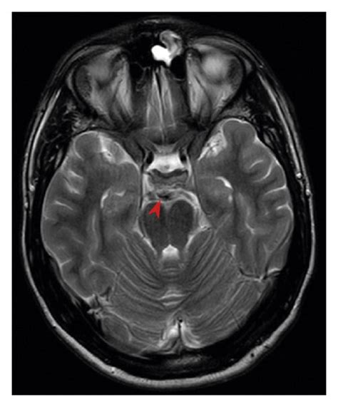 Axial T2 Weighted Mri Images Comparison A No Focal Or Wide