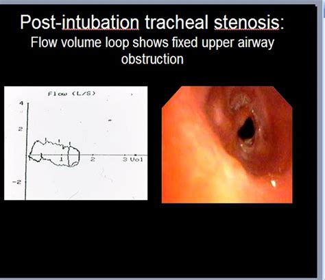 Disorders Of The Central Airways And Upper Airway Obstruction