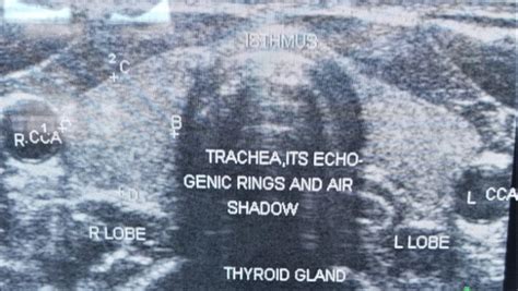 The Transverse Thyroid Scan Showing Both Lobes And The Isthmus As Well