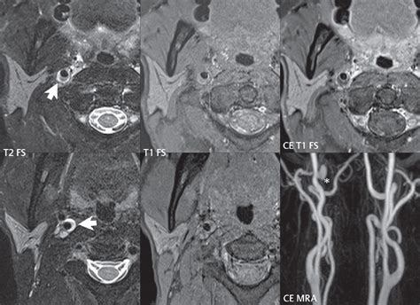 6 Vascular Malformations And Other Vascular Lesions Radiology Key