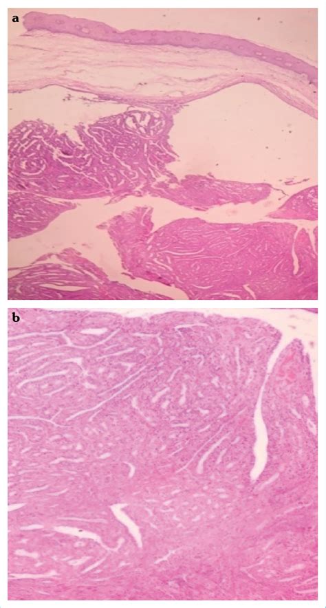 A Hematoxylin And Eosin Stained Section Of Hidradenoma Papilliferum