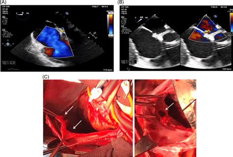 Intraoperative Transesophageal Echocardiogram Showing Moderate‐severe