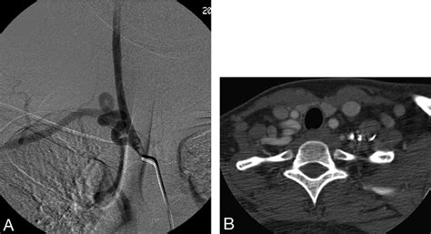 Injection Of The Innominate Artery A And Ct Scan Obtained At The