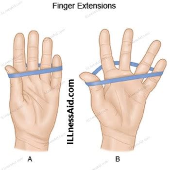 What is Carpal Boss Syndrome/ Os Styloideum? - ILLnessAid