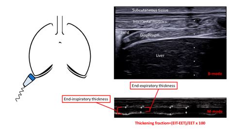 Ultrasonographic Assessment Of Diaphragm Thickness And Thickening