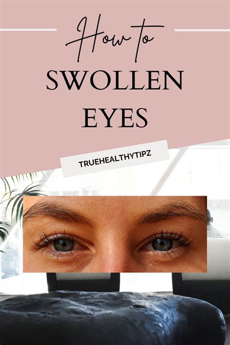 Swollen Eyes | Swollen eyes, Swollen eyelids remedy, Dry itchy eyes