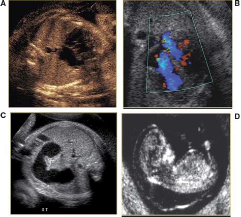 The Second Trimester Genetic Sonogram Breathnach 2007 American Journal Of Medical Genetics