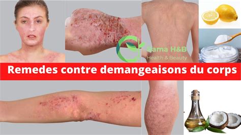 COMMENT CALMER LES DÉMANGEAISONS DU CORPS Rama Health Beauty