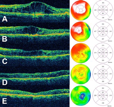 A A Horizontal Optical Coherence Tomography Oct Scans Obtained